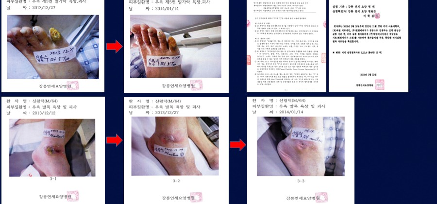 욕창·족부궤양 캘비 파우더 천연 겔 처치 전·후 기록 (강릉연세요양병원)